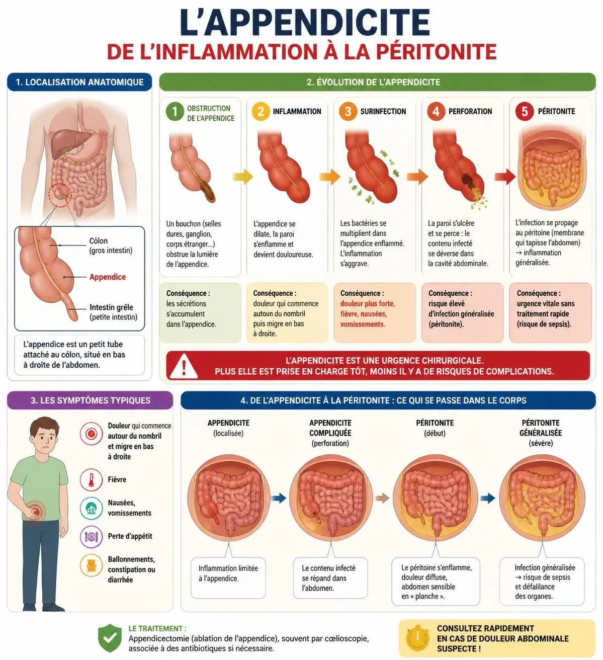 découvrez comment reconnaître les symptômes de l'appendicite, pourquoi c'est une urgence médicale et ce à quoi s'attendre lors de l'opération.